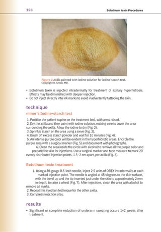 128 Botulinum toxin Procedures
•
•
• Significant or complete reduction of underarm sweating occurs 1–2 weeks after
treatment.
Botulinum toxin is injected intradermally for treatment of axillary hyperhidrosis.
Effects may be diminished with deeper injection.
Do not inject directly into ink marks to avoid inadvertently tattooing the skin.
1. Position the patient supine on the treatment bed, with arms raised.
2. Dry the axilla and then paint with iodine solution, making sure to cover the area
surrounding the axilla. Allow the iodine to dry (Fig. 2).
3. Sprinkle starch on the area using a sieve (Fig. 3).
4. Brush off excess starch powder and wait for 10 minutes (Fig. 4).
5. An intense purple color will be evident in the hyperhidrotic areas. Encircle the
purple area with a surgical marker (Fig. 5) and document with photographs.
6. Clean the area inside the circle with alcohol to remove all the purple color and
prepare the skin for injections. Use a surgical marker and tape measure to mark 20
evenly distributed injection points, 1.5–2 cm apart, per axilla (Fig. 6).
1. Using a 30-gauge 0.5-inch needle, inject 2.5 units of OBTX intradermally at each
marked injection point. The needle is angled at 45-degrees to the skin surface,
with the bevel up and the tip inserted just under the skin to approximately 2 mm
in depth, to raise a wheal (Fig. 7). After injections, clean the area with alcohol to
remove all marks.
2. Repeat this injection technique for the other axilla.
3. Compress injection sites.
results
technique
minor’s Iodine-starch test
Botulinum toxin treatment
●
Figure 2 Axilla painted with iodine solution for iodine-starch test.
Copyright R. Small, MD.
 