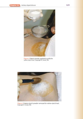129
Chapter 12 Axillary Hyperhidrosis
●
●
Figure 3 Starch powder applied to axilla for
iodine-starch test. Copyright R. Small, MD.
Figure 4 Excess starch powder removed for iodine-starch test.
Copyright R. Small, MD.
 