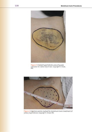 130 Botulinum toxin Procedures
●
●
Figure 5 Circled hyperhidrotic area of purple
coloration for iodine-starch test. Copyright R. Small,
MD.
Figure 6 Injection points marked for botulinum toxin treatment of
axillary hyperhidrosis. Copyright R. Small, MD.
 