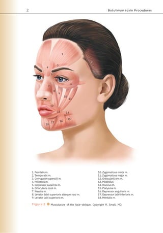 2 Botulinum toxin Procedures
4
18
7
5
12
17
8
3
9
13
16
1
14
15
10
11
6
1. Frontalis m.
2. Temporalis m.
3. Corrugator supercilii m.
4. Procerus m.
5. Depressor supercilii m.
6. Orbicularis oculi m.
7. Nasalis m.
8. Levator labii superioris alaeque nasi m.
9. Levator labii superioris m.
2
10. Zygomaticus minor m.
11. Zygomaticus major m.
12. Orbicularis oris m.
13. Modeolus
14. Risorius m.
15. Platysma m.
16. Depressor anguli oris m.
17. Depressor labii inferioris m.
18. Mentalis m.
Figure 2 ● Musculature of the face–oblique. Copyright R. Small, MD.
 