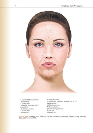 4 Botulinum toxin Procedures
3
1. Horizontal forehead lines
(Frontalis m.)
2. Frown lines
(Glabellar complex m.) 3.
Crow’s feet
(Orbicularis oculi m.)
4. Bunny lines
(Nasalis m.)
7
5
6
4
2
8
1
5. Nasolabial folds
(Levator labii superioris alaeque nasi m.) 6.
Radial lip lines
(Orbicularis oris m.)
7. Marionette lines
(Depressor anguli oris m.)
8. Chin line
(Mentalis m.)
Figure 4 ● Wrinkles and folds of the face–anterior-posterior (contributing muscle).
Copyright R. Small, MD.
 