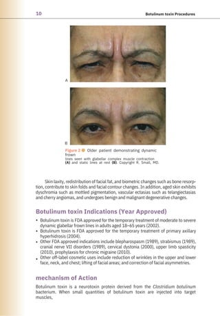 10 Botulinum toxin Procedures
Botulinum toxin is a neurotoxin protein derived from the Clostridium botulinum
bacterium. When small quantities of botulinum toxin are injected into target
muscles,
Skin laxity, redistribution of facial fat, and biometric changes such as bone resorp-
tion, contribute to skin folds and facial contour changes. In addition, aged skin exhibits
dyschromia such as mottled pigmentation, vascular ectasias such as telangiectasias
and cherry angiomas, and undergoes benign and malignant degenerative changes.
Botulinum toxin is FDA approved for the temporary treatment of moderate to severe
dynamic glabellar frown lines in adults aged 18–65 years (2002).
Botulinum toxin is FDA approved for the temporary treatment of primary axillary
hyperhidrosis (2004).
Other FDA approved indications include blepharospasm (1989), strabismus (1989),
cranial nerve VII disorders (1989), cervical dystonia (2000), upper limb spasticity
(2010), prophylaxsis for chronic migraine (2010).
Other off-label cosmetic uses include reduction of wrinkles in the upper and lower
face, neck, and chest; lifting of facial areas; and correction of facial asymmetries.
mechanism of Action
Botulinum toxin Indications (Year Approved)
•
•
•
•
B
A
Figure 2 ● Older patient demonstrating dynamic
frown
lines seen with glabellar complex muscle contraction
(A) and static lines at rest (B). Copyright R. Small, MD.
 