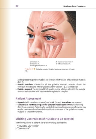 26 Botulinum Toxin Procedures
2
4
3
1. Frontalis m.
2. Procerus m.
3. Corrugator supercilii m.
1
5
4. Depressor supercilii m.
5. Orbicularis oculi m.
Figure 2 ●
MD.
Glabellar complex detailed anatomy. Copyright R. Small,
Instruct the patient to perform any of the following expressions:
• “Frown like you’re mad”
• “Concentrate”
Dynamic (with muscle contraction) and static (at rest) frown lines are assessed.
Concomitant frontalis and glabellar complex muscle contraction with frowning
(Fig. 3) are assessed. Patients who use both these muscle groups when frowning may
require treatment of the frontalis in addition to treatment of the glabellar complex
muscles to smooth frown lines.
and depressor supercilii muscles lie beneath the frontalis and procerus muscles
(Fig. 2).
Muscle functions. Contraction of the glabellar complex muscles draws the
eyebrows medially and inferiorly (see Anatomy section; Fig. 7 and Table 1).
Muscles avoided. The portion of the frontalis muscle which is lateral to the corruga-
tor muscles is avoided with treatment of the glabellar complex.
•
•
•
•
Patient Assessment
Eliciting Contraction of Muscles to Be Treated
 