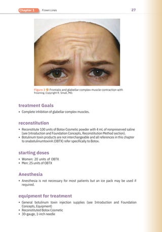 27
Chapter 1 Frown Lines
Figure 3 ●Frontalis and glabellar complex muscle contraction with
frowning. Copyright R. Small, MD.
Anesthesia
reconstitution
starting doses
treatment Goals
equipment for treatment
•
•
•
•
•
•
•
•
•
Women: 20 units of OBTX
Men: 25 units of OBTX
Complete inhibition of glabellar complex muscles.
Anesthesia is not necessary for most patients but an ice pack may be used if
required.
Reconstitute 100 units of Botox Cosmetic powder with 4 mL of nonpreserved saline
(see Introduction and Foundation Concepts, Reconstitution Method section).
Botulinum toxin products are not interchangeable and all references in this chapter
to onabotulinumtoxinA (OBTX) refer specifically to Botox.
General botulinum toxin injection supplies (see Introduction and Foundation
Concepts, Equipment)
Reconstituted Botox Cosmetic
30-gauge, 1-inch needle
 