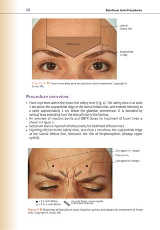28 Botulinum toxin Procedures
Figure 4 ●
Small, MD.
Frown line safety zone for botulinum toxin treatments. Copyright R.
Figure 5 ●Overview of botulinum toxin injection points and doses for treatment of frown
lines. Copyright R. Small, MD.
= 2.5 units Botox
= 2.5–5 units Botox
Safety zone
=5 units Botox, insert needle
in direction of arrow
1 cm
Supraorbita
l r idge
Lateral
limbus line
Corrugator m. margin
Procerus m.
Corrugator m. margin
Procedure overview
•
•
•
•
Place injections within the frown line safety zone (Fig. 4). The safety zone is at least
1 cm above the supraorbital ridge at the lateral limbus line, and extends inferiorly to
a point approximately 1 cm below the glabellar prominence. It is bounded by
vertical lines extending from the lateral limbi to the hairline.
An overview of injection points and OBTX doses for treatment of frown lines is
shown in Figure 5.
Botulinum toxin is injected intramuscularly for treatment of frown lines.
Injecting inferior to the safety zone, less than 1 cm above the supraorbital ridge
at the lateral limbus line, increases the risk of blepharoptosis (droopy upper
eyelid).
 
