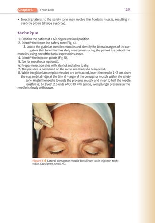 29
Chapter 1 Frown Lines
• Injecting lateral to the safety zone may involve the frontalis muscle, resulting in
eyebrow ptosis (droopy eyebrow).
1. Position the patient at a 60-degree reclined position.
2. Identify the frown line safety zone (Fig. 4).
3. Locate the glabellar complex muscles and identify the lateral margins of the cor-
rugators that lie within the safety zone by instructing the patient to contract the
muscles, using one of the facial expressions above.
4. Identify the injection points (Fig. 5).
5. Ice for anesthesia (optional).
6. Prepare injection sites with alcohol and allow to dry.
7. The provider is positioned on the same side that is to be injected.
8. While the glabellar complex muscles are contracted, insert the needle 1–2 cm above
the supraorbital ridge at the lateral margin of the corrugator muscle within the safety
zone. Angle the needle towards the procerus muscle and insert to half the needle
length (Fig. 6). Inject 2.5 units of OBTX with gentle, even plunger pressure as the
needle is slowly withdrawn.
technique
Figure 6 ●Lateral corrugator muscle botulinum toxin injection tech-
nique. Copyright R. Small, MD.
 
