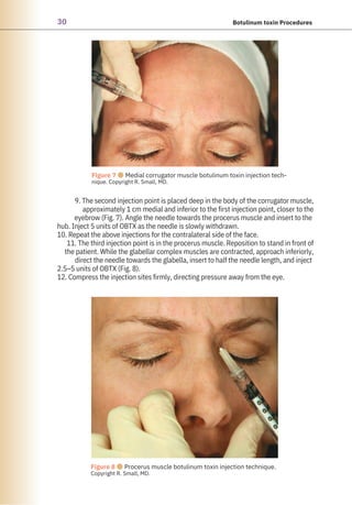 30 Botulinum toxin Procedures
Figure 8 ●Procerus muscle botulinum toxin injection technique.
Copyright R. Small, MD.
Figure 7 ●Medial corrugator muscle botulinum toxin injection tech-
nique. Copyright R. Small, MD.
9. The second injection point is placed deep in the body of the corrugator muscle,
approximately 1 cm medial and inferior to the first injection point, closer to the
eyebrow (Fig. 7). Angle the needle towards the procerus muscle and insert to the
hub. Inject 5 units of OBTX as the needle is slowly withdrawn.
10. Repeat the above injections for the contralateral side of the face.
11. The third injection point is in the procerus muscle. Reposition to stand in front of
the patient. While the glabellar complex muscles are contracted, approach inferiorly,
direct the needle towards the glabella, insert to half the needle length, and inject
2.5–5 units of OBTX (Fig. 8).
12. Compress the injection sites firmly, directing pressure away from the eye.
 
