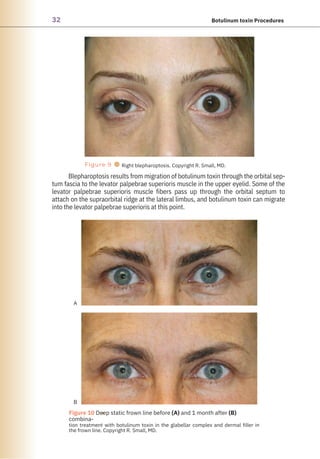 32 Botulinum toxin Procedures
Figure 9
●
● Right blepharoptosis. Copyright R. Small, MD.
Figure 10 Deep static frown line before (A) and 1 month after (B)
combina-
tion treatment with botulinum toxin in the glabellar complex and dermal filler in
the frown line. Copyright R. Small, MD.
A
B
Blepharoptosis results from migration of botulinum toxin through the orbital sep-
tum fascia to the levator palpebrae superioris muscle in the upper eyelid. Some of the
levator palpebrae superioris muscle fibers pass up through the orbital septum to
attach on the supraorbital ridge at the lateral limbus, and botulinum toxin can migrate
into the levator palpebrae superioris at this point.
 