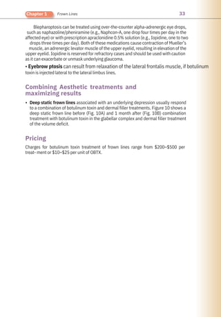 33
Chapter 1 Frown Lines
Charges for botulinum toxin treatment of frown lines range from $200–$500 per
treat- ment or $10–$25 per unit of OBTX.
Deep static frown lines associated with an underlying depression usually respond
to a combination of botulinum toxin and dermal filler treatments. Figure 10 shows a
deep static frown line before (Fig. 10A) and 1 month after (Fig. 10B) combination
treatment with botulinum toxin in the glabellar complex and dermal filler treatment
of the volume deficit.
Blepharoptosis can be treated using over-the-counter alpha-adrenergic eye drops,
such as naphazoline/pheniramine (e.g., Naphcon-A, one drop four times per day in the
affected eye) or with prescription apraclonidine 0.5% solution (e.g., Iopidine, one to two
drops three times per day). Both of these medications cause contraction of Mueller’s
muscle, an adrenergic levator muscle of the upper eyelid, resulting in elevation of the
upper eyelid. Iopidine is reserved for refractory cases and should be used with caution
as it can exacerbate or unmask underlying glaucoma.
• Eyebrow ptosis can result from relaxation of the lateral frontalis muscle, if botulinum
toxin is injected lateral to the lateral limbus lines.
•
Pricing
Combining Aesthetic treatments and
maximizing results
 