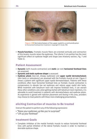 36 Botulinum toxin Procedures
•
•
•
•
•
Instruct the patient to perform any of the following expressions:
• “Raise your eyebrows up like you’re surprised”
• “Lift up your forehead”
Muscle functions. Frontalis muscle fibers are oriented vertically and contraction
of this levator muscle raises the eyebrows. The inferior 2-cm portion has the most
significant effect on eyebrow height and shape (see Anatomy section, Fig. 7 and
Table 1).
Complete inhibition of the medial frontalis muscle to reduce horizontal forehead
lines with partial inhibition of the lateral frontalis muscle in order to maintain a
desirable eyebrow shape.
Dynamic (with muscle contraction) and static (at rest) horizontal forehead lines
are assessed.
Dynamic and static eyebrow shape is assessed.
Eyebrow ptosis (low-set, droopy eyebrows) and upper eyelid dermatochalasis
(skin laxity or redundancy) are assessed with the frontalis muscle at rest. Figure 2
shows a patient with significant upper eyelid dermatochalasis. Patients with these
conditions often have horizontal forehead lines as frontalis muscle contraction is
compensatory to elevate low set eyebrows and reduce upper eyelid skin laxity.
While treatment with botulinum toxin will improve forehead lines, it can worsen
these other conditions and, when getting started with botulinum toxin injections, it is
advisable to avoid treatment in patients with dermatochalasis and eyebrow ptosis.
As experience is gained with injection placement and dosing in this area, providers
may choose to treat patients with these more challenging presentations.
treatment Goals
Patient Assessment
eliciting Contraction of muscles to Be treated
Figure 2 ●Dermatochalasis of the upper eyelid is a contraindication
to horizontal forehead line treatment. Copyright R. Small, MD.
 