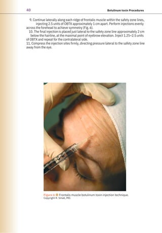 40 Botulinum toxin Procedures
9. Continue laterally along each ridge of frontalis muscle within the safety zone lines,
injecting 2.5 units of OBTX approximately 1 cm apart. Perform injections evenly
across the forehead to achieve symmetry (Fig. 6).
10. The final injection is placed just lateral to the safety zone line approximately 2 cm
below the hairline, at the maximal point of eyebrow elevation. Inject 1.25–2.5 units
of OBTX and repeat for the contralateral side.
11. Compress the injection sites firmly, directing pressure lateral to the safety zone line
away from the eye.
Figure 6 ●Frontalis muscle botulinum toxin injection technique.
Copyright R. Small, MD.
 