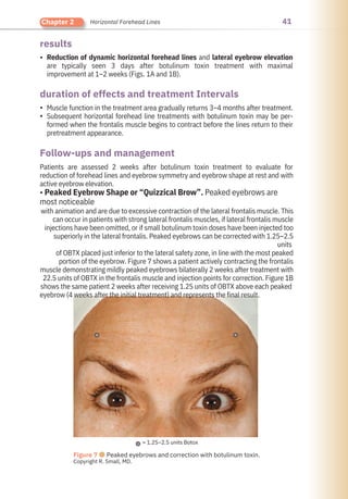 41
Chapter 2 Horizontal Forehead Lines
results
Follow-ups and management
duration of effects and treatment Intervals
•
•
•
Muscle function in the treatment area gradually returns 3–4 months after treatment.
Subsequent horizontal forehead line treatments with botulinum toxin may be per-
formed when the frontalis muscle begins to contract before the lines return to their
pretreatment appearance.
Reduction of dynamic horizontal forehead lines and lateral eyebrow elevation
are typically seen 3 days after botulinum toxin treatment with maximal
improvement at 1–2 weeks (Figs. 1A and 1B).
Patients are assessed 2 weeks after botulinum toxin treatment to evaluate for
reduction of forehead lines and eyebrow symmetry and eyebrow shape at rest and with
active eyebrow elevation.
• Peaked Eyebrow Shape or “Quizzical Brow”. Peaked eyebrows are
most noticeable
with animation and are due to excessive contraction of the lateral frontalis muscle. This
can occur in patients with strong lateral frontalis muscles, if lateral frontalis muscle
injections have been omitted, or if small botulinum toxin doses have been injected too
superiorly in the lateral frontalis. Peaked eyebrows can be corrected with 1.25–2.5
units
of OBTX placed just inferior to the lateral safety zone, in line with the most peaked
portion of the eyebrow. Figure 7 shows a patient actively contracting the frontalis
muscle demonstrating mildly peaked eyebrows bilaterally 2 weeks after treatment with
22.5 units of OBTX in the frontalis muscle and injection points for correction. Figure 1B
shows the same patient 2 weeks after receiving 1.25 units of OBTX above each peaked
eyebrow (4 weeks after the initial treatment) and represents the final result.
= 1.25–2.5 units Botox
Figure 7 ●Peaked eyebrows and correction with botulinum toxin.
Copyright R. Small, MD.
 
