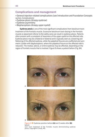 42 Botulinum toxin Procedures
Complications and management
• General injection-related complications (see Introduction and Foundation Concepts
section, Complications)
• Eyebrow ptosis (droopy eyebrow)
• Eyebrow asymmetry
• Blepharoptosis (droopy upper eyelid)
Eyebrow ptosis is one of the most significant complications from botulinum toxin
treatment of the frontalis muscle. Excessive botulinum toxin dosing in the frontalis
muscle or placement inferior to the safety zone can result in eyebrow ptosis. Patients
often present with a complaint of heaviness of the upper eyelid on the affected side.
Eyebrow ptosis may be unilateral or bilateral and is typically seen as a lowering and
flattening of the affected eyebrow, while the palpebral fissures are unaffected and sym-
metric (unlike with blepharoptosis, where the palpebral fissure on the affected side is
reduced). The medial, lateral, or entire eyebrow may be affected, depending on the
region of frontalis muscle that is involved. Figure 8 shows a patient before (Fig. 8A)
A
B
Figure 8 ●Eyebrow position before (A) and 2 weeks after (B)
botuli-
num toxin treatment of the frontalis muscle demonstrating eyebrow
ptosis. Copyright R. Small, MD.
 