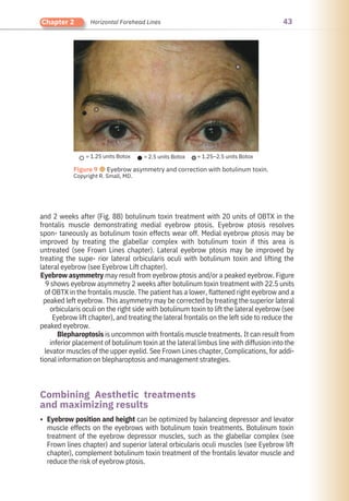 43
Chapter 2 Horizontal Forehead Lines
Eyebrow position and height can be optimized by balancing depressor and levator
muscle effects on the eyebrows with botulinum toxin treatments. Botulinum toxin
treatment of the eyebrow depressor muscles, such as the glabellar complex (see
Frown lines chapter) and superior lateral orbicularis oculi muscles (see Eyebrow lift
chapter), complement botulinum toxin treatment of the frontalis levator muscle and
reduce the risk of eyebrow ptosis.
and 2 weeks after (Fig. 8B) botulinum toxin treatment with 20 units of OBTX in the
frontalis muscle demonstrating medial eyebrow ptosis. Eyebrow ptosis resolves
spon- taneously as botulinum toxin effects wear off. Medial eyebrow ptosis may be
improved by treating the glabellar complex with botulinum toxin if this area is
untreated (see Frown Lines chapter). Lateral eyebrow ptosis may be improved by
treating the supe- rior lateral orbicularis oculi with botulinum toxin and lifting the
lateral eyebrow (see Eyebrow Lift chapter).
Eyebrow asymmetry may result from eyebrow ptosis and/or a peaked eyebrow. Figure
9 shows eyebrow asymmetry 2 weeks after botulinum toxin treatment with 22.5 units
of OBTX in the frontalis muscle. The patient has a lower, flattened right eyebrow and a
peaked left eyebrow. This asymmetry may be corrected by treating the superior lateral
orbicularis oculi on the right side with botulinum toxin to lift the lateral eyebrow (see
Eyebrow lift chapter), and treating the lateral frontalis on the left side to reduce the
peaked eyebrow.
Blepharoptosis is uncommon with frontalis muscle treatments. It can result from
inferior placement of botulinum toxin at the lateral limbus line with diffusion into the
levator muscles of the upper eyelid. See Frown Lines chapter, Complications, for addi-
tional information on blepharoptosis and management strategies.
Combining Aesthetic treatments
and maximizing results
•
= 1.25 units Botox = 2.5 units Botox = 1.25–2.5 units Botox
Figure 9 ●Eyebrow asymmetry and correction with botulinum toxin.
Copyright R. Small, MD.
 