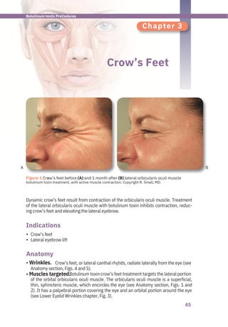 45
Chapter 3
Crow’s Feet
Crow’s feet
Lateral eyebrow lift
Dynamic crow’s feet result from contraction of the orbicularis oculi muscle. Treatment
of the lateral orbicularis oculi muscle with botulinum toxin inhibits contraction, reduc-
ing crow’s feet and elevating the lateral eyebrow.
Crow’s feet, or lateral canthal rhytids, radiate laterally from the eye (see
Anatomy section, Figs. 4 and 5).
Botulinum toxin crow’s feet treatment targets the lateral portion
of the orbital orbicularis oculi muscle. The orbicularis oculi muscle is a superficial,
thin, sphincteric muscle, which encircles the eye (see Anatomy section, Figs. 1 and
2). It has a palpebral portion covering the eye and an orbital portion around the eye
(see Lower Eyelid Wrinkles chapter, Fig. 3).
Anatomy
Indications
•
•
• Wrinkles.
• Muscles targeted.
A B
●
Figure 1 Crow’s feet before (A) and 1 month after (B) lateral orbicularis oculi muscle
botulinum toxin treatment, with active muscle contraction. Copyright R. Small, MD.
BotulInum toxIn ProCedures
 