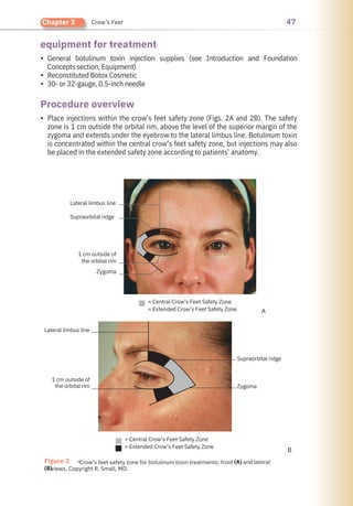 47
Chapter 3 Crow’s Feet
Procedure overview
equipment for treatment
•
•
•
•
Place injections within the crow’s feet safety zone (Figs. 2A and 2B). The safety
zone is 1 cm outside the orbital rim, above the level of the superior margin of the
zygoma and extends under the eyebrow to the lateral limbus line. Botulinum toxin
is concentrated within the central crow’s feet safety zone, but injections may also
be placed in the extended safety zone according to patients’ anatomy.
General botulinum toxin injection supplies (see Introduction and Foundation
Concepts section, Equipment)
Reconstituted Botox Cosmetic
30- or 32-gauge, 0.5-inch needle
Figure 2 ●Crow’s feet safety zone for botulinum toxin treatments: front
views. Copyright R. Small, MD.
and lateral
(B)
(A)
Lateral limbus line
1 cm outside of
the orbital rim
Lateral limbus line
Supraorbital ridge
1 cm outside of
the orbital rim
Zygoma
= Central Crow’s Feet Safety Zone
= Extended Crow’s Feet Safety Zone
= Central Crow’s Feet Safety Zone
= Extended Crow’s Feet Safety Zone
Zygoma
Supraorbital ridge
A
B
 