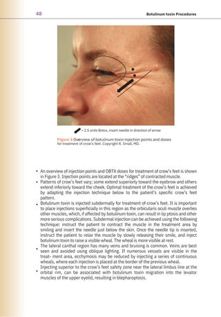 48 Botulinum toxin Procedures
•
•
•
•
•
An overview of injection points and OBTX doses for treatment of crow’s feet is shown
in Figure 3. Injection points are located at the “ridges” of contracted muscle.
Patterns of crow’s feet vary; some extend superiorly toward the eyebrow and others
extend inferiorly toward the cheek. Optimal treatment of the crow’s feet is achieved
by adapting the injection technique below to the patient’s specific crow’s feet
pattern.
Botulinum toxin is injected subdermally for treatment of crow’s feet. It is important
to place injections superficially in this region as the orbicularis oculi muscle overlies
other muscles, which, if affected by botulinum toxin, can result in lip ptosis and other
more serious complications. Subdermal injection can be achieved using the following
technique: instruct the patient to contract the muscle in the treatment area by
smiling and insert the needle just below the skin. Once the needle tip is inserted,
instruct the patient to relax the muscle by slowly releasing their smile, and inject
botulinum toxin to raise a visible wheal. The wheal is more visible at rest.
The lateral canthal region has many veins and bruising is common. Veins are best
seen and avoided using oblique lighting. If numerous vessels are visible in the
treat- ment area, ecchymosis may be reduced by injecting a series of continuous
wheals, where each injection is placed at the border of the previous wheal.
Injecting superior to the crow’s feet safety zone near the lateral limbus line at the
orbital rim, can be associated with botulinum toxin migration into the levator
muscles of the upper eyelid, resulting in blepharoptosis.
= 2.5 units Botox, insert needle in direction of arrow
●
Figure 3 Overview of botulinum toxin injection points and doses
for treatment of crow’s feet. Copyright R. Small, MD.
 
