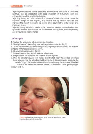 49
Chapter 3 Crow’s Feet
•
•
•
Injecting medial to the crow’s feet safety zone near the orbital rim at the lateral
canthus, can be associated with deep migration of botulinum toxin into
extraocular muscles, resulting in diplopia.
Injecting deeply and inferior lateral to the crow’s feet safety zone below the
superior margin of the zygoma, may involve the lip levator muscles and
increase the risk of cheek and lip ptosis, smile asymmetry, and possibly oral
incompe- tence.
Injecting deeply and inferior medial to the crow’s feet safety zone may involve other
lip levator muscles and increase the risk of cheek and lip ptosis, smile asymmetry,
and profound oral incompetence.
1. Position the patient at a 60-degree reclined position.
2. Identify the crow’s feet safety zone and palpate the orbital rim (Fig. 2).
3. Locate the orbicularis oculi muscle by instructing the patient to contract the muscles
using one of the facial expressions above.
4. Identify the injection points (Fig. 3).
5. Prepare injection sites with alcohol and allow to dry.
6. The provider is positioned on the side that is to be injected.
7. While the lateral orbicularis oculi muscle is contracted, insert the needle 1 cm outside
the orbital rim, near the lateral canthal line into the first injection point located at the
muscle “ridge”. The needle is inserted subdermally using the technique described
earlier in the Procedure Overview. Inject 2.5 units of OBTX with gentle plunger
pressure (Fig. 4).
technique
●
Figure 4 First lateral orbicularis oculi muscle botulinum toxin
injection. Copyright R. Small, MD.
 