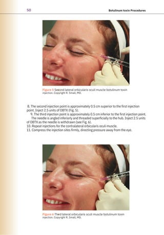 50 Botulinum toxin Procedures
8. The second injection point is approximately 0.5 cm superior to the first injection
point. Inject 2.5 units of OBTX (Fig. 5).
9. The third injection point is approximately 0.5 cm inferior to the first injection point.
The needle is angled inferiorly and threaded superficially to the hub. Inject 2.5 units
of OBTX as the needle is withdrawn (see Fig. 6).
10. Repeat injections for the contralateral orbicularis oculi muscle.
11. Compress the injection sites firmly, directing pressure away from the eye.
●
●
Figure 6 Third lateral orbicularis oculi muscle botulinum toxin
injection. Copyright R. Small, MD.
Figure 5 Second lateral orbicularis oculi muscle botulinum toxin
injection. Copyright R. Small, MD.
 