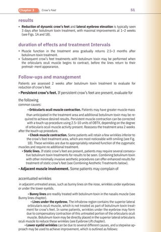 51
Chapter 3 Crow’s Feet
results
Follow-ups and management
duration of effects and treatment Intervals
•
•
•
Reduction of dynamic crow’s feet and lateral eyebrow elevation is typically seen
3 days after botulinum toxin treatment, with maximal improvements at 1–2 weeks
(see Figs. 1A and 1B).
Muscle function in the treatment area gradually returns 2.5–3 months after
botulinum toxin treatment.
Subsequent crow’s feet treatments with botulinum toxin may be performed when
the orbicularis oculi muscle begins to contract, before the lines return to their
pretreat- ment appearance.
Patients are assessed 2 weeks after botulinum toxin treatment to evaluate for
reduction of crow’s feet.
• Persistent crow’s feet. If persistent crow’s feet are present, evaluate for
the following
common causes:
• Orbicularis oculi muscle contraction. Patients may have greater muscle mass
than anticipated in the treatment area and additional botulinum toxin may be re-
quired to achieve desired results. Persistent muscle contraction can be corrected
with a touch-up procedure using 2.5–10 units of OBTX, depending on the degree
of orbicularis oculi muscle activity present. Reassess the treatment area 2 weeks
after the touch-up procedure.
• Cheek muscle contraction. Some patients will retain a few wrinkles inferior to
the crow’s feet treatment area, which are most noticeable with smiling (see Fig.
1B). These wrinkles are due to appropriately retained function of the zygomatic
muscles and require no additional treatment.
• Static lines. If static crow’s feet are present, patients may require several consecu-
tive botulinum toxin treatments for results to be seen. Combining botulinum toxin
with other minimally invasive aesthetic procedures can offer enhanced results for
treatment of static crow’s feet (see Combining Aesthetic Treatments below).
• Adjacent muscle involvement. Some patients may complain of
accentuated wrinkles
in adjacent untreated areas, such as bunny lines on the nose, wrinkles under eyebrows
or under the lower eyelids.
• Bunny lines are readily treated with botulinum toxin in the nasalis muscle (see
Bunny lines chapter).
• Lines under the eyebrow. The infrabrow region contains the superior lateral
orbicularis oculi muscle, which is not treated as part of botulinum toxin treat-
ment for crow’s feet. In some patients, wrinkles under the eyebrow may form
due to compensatory contraction of this untreated portion of the orbicularis oculi
muscle. Botulinum toxin may be directly placed in the superior lateral orbicularis
oculi muscle to reduce these wrinkles (see Eyebrow Lift chapter).
• Lower eyelid wrinkles can be due to several different causes, and a stepwise ap-
proach may be used to achieve improvement, which is outlined as follows:
 