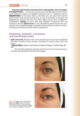 53
Chapter 3 Crow’s Feet
Impaired eyelid function and altered lower eyelid position, such as ectropion
and lagophthalmos,
Xerophthalmia,
Static crow’s feet. Botulinum toxin in the orbicularis oculi muscle can be combined
with other minimally invasive aesthetic procedures to enhance static crow’s feet
results.
• Dermal fillers. Static crow’s feet are shown in Figure 7, before (Fig. 7A)
and
after (Fig. 7B) combination treatment with botulinum toxin in the orbicularis oc-
uli muscle and dermal filler treatment of the zygoma.
are very rare and can occur with high botulinum toxin doses
which excessively weaken the palpebral orbicularis oculi, or if botulinum toxin is
placed too close to the eyelid. which is extremely rare, can result from impaired
eyelid function with reduced lacrimal flow, or may be secondary to ectropion and
lagophthalmos. Patients who have had LASIK surgery may be more susceptible to
xerophthalmia. Diplopia can occur with deep migration of botulinum toxin into
extraocular muscles. Globe trauma is a risk with injections placed near the eye. Con-
sultation with an ophthalmologist is advisable with any of these conditions to help in
preventing corneal injury and other ocular complications.
Combining Aesthetic treatments
and maximizing results
•
●
(B)
Figure 7 Static crow’s feet before
(A) and after combination treatment
with botulinum toxin in the orbicularis
oculi muscle and dermal filler treatment
of the zygoma. Copyright R. Small, MD.
A
B
 