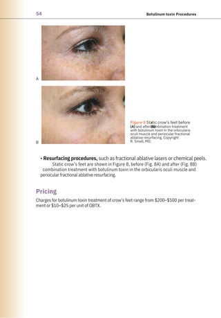 54 Botulinum toxin Procedures
Charges for botulinum toxin treatment of crow’s feet range from $200–$500 per treat-
ment or $10–$25 per unit of OBTX.
• Resurfacing procedures, such as fractional ablative lasers or chemical peels.
Static crow’s feet are shown in Figure 8, before (Fig. 8A) and after (Fig. 8B)
combination treatment with botulinum toxin in the orbicularis oculi muscle and
periocular fractional ablative resurfacing.
Pricing
A
B
●
(B)
Figure 8 Static crow’s feet before
(A) and after combination treatment
with botulinum toxin in the orbicularis
oculi muscle and periocular fractional
ablative resurfacing. Copyright
R. Small, MD.
 