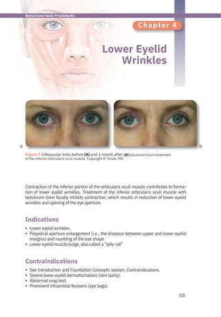 55
A B
Chapter 4
Lower Eyelid
Wrinkles
See Introduction and Foundation Concepts section, Contraindications.
Severe lower eyelid dermatochalasis (skin laxity).
Abnormal snap test.
Prominent infraorbital festoons (eye bags).
Lower eyelid wrinkles
Palpebral aperture enlargement (i.e., the distance between upper and lower eyelid
margins) and rounding of the eye shape
Lower eyelid muscle bulge, also called a “jelly roll”
Contraction of the inferior portion of the orbicularis oculi muscle contributes to forma-
tion of lower eyelid wrinkles. Treatment of the inferior orbicularis oculi muscle with
botulinum toxin focally inhibits contraction, which results in reduction of lower eyelid
wrinkles and opening of the eye aperture.
Indications
Contraindications
•
•
•
•
•
•
•
●
Figure 1 Infraocular lines before (A) and 1 month after
of the inferior orbicularis oculi muscle. Copyright R. Small, MD.
botulinum toxin treatment
BotuLInum toxIn ProCEdurEs
(B)
 