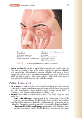 57
Chapter 4 Lower Eyelid Wrinkles
•
•
•
Muscle functions. Contraction of several different muscles and muscle regions can
contribute to formation of lower eyelid wrinkles including the: preseptal orbicularis
oculi medial to the mid pupilary line, preseptal orbicularis oculi lateral to the mid
pupilary line, and lip levators such as zygomaticus major and levator labii superioris
which primarily functions as a lip levator. A lower eyelid muscle bulge is due to
contraction of the palpebral portion of the orbicularis muscle.
Facial surgery history is obtained, including blepharoplasty and skin resurfacing
procedures such as ablative laser resurfacing or deep chemical peels of the lower
eye- lids. Ophthalmologic history including keratorefractive surgery (LASIK) is
obtained as these patients may have a greater risk of dry eyes.
Dynamic (with muscle contraction) assessments of the lower eyelid are made
includ- ing:
• Lower eyelid wrinkles are evaluated while having the patient perform one of the
facial expressions listed below (Fig. 2A). The botulinum toxin injection techniques
described in this chapter can reduce lower eyelid wrinkles at or lateral to the mid pu-
pilary line. They do not reduce lower eyelid wrinkles medial to the mid pupilary line.
• Lower eyelid wrinkles muscle bulge is also assessed while the patient is con-
tracting the lower eyelid muscles (Fig. 2A). Botulinum toxin injection of the lower
Patient Assessment
2
4
3
7
1
1. Frontalis m.
2. Procerus m.
3. Corrugator supercilii m.
4. Depressor supercilli m.
5. Orbicularis oculi m. (orbital portion)
6a
6b
6a
8
5
9
6. Orbicularis oculi m. (palpebral portion)
a. Preseptal
b. Pretarsal
7. Levator labii superioris m.
8. Zygomaticus minor m.
9. Zygomaticus major m.
Figure 3 ● Periocular detailed anatomy. Copyright R. Small, MD.
 