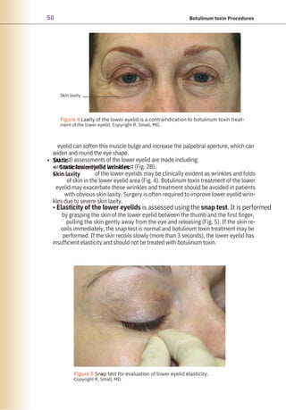 58 Botulinum toxin Procedures
eyelid can soften this muscle bulge and increase the palpebral aperture, which can
widen and round the eye shape.
(at rest) assessments of the lower eyelid are made including:
are assessed with the face at rest (Fig. 2B).
of the lower eyelids may be clinically evident as wrinkles and folds
of skin in the lower eyelid area (Fig. 4). Botulinum toxin treatment of the lower
eyelid may exacerbate these wrinkles and treatment should be avoided in patients
with obvious skin laxity. Surgery is often required to improve lower eyelid wrin-
kles due to severe skin laxity.
• Elasticity of the lower eyelids is assessed using the snap test. It is performed
by grasping the skin of the lower eyelid between the thumb and the first finger,
pulling the skin gently away from the eye and releasing (Fig. 5). If the skin re-
coils immediately, the snap test is normal and botulinum toxin treatment may be
performed. If the skin recoils slowly (more than 3 seconds), the lower eyelid has
insufficient elasticity and should not be treated with botulinum toxin.
•
•
•
Static
Static lowereyelid wrinkles
Skin laxity
●
●
Figure 5 Snap test for evaluation of lower eyelid elasticity.
Copyright R. Small, MD.
Figure 4 Laxity of the lower eyelid is a contraindication to botulinum toxin treat-
ment of the lower eyelid. Copyright R. Small, MD.
Skin laxity
 