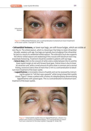 59
Chapter 4 Lower Eyelid Wrinkles
• Infraorbital festoons, or lower eye bags, are soft tissue bulges, which are visible at
rest (Fig. 6). The orbital septum, which is a facial layer that helps to retain infraorbital
fat pads, weakens with age. Eye bags are typically due to bulging of the infraorbital
fat pad as a result of a weakened orbital septum. The orbicularis oculi also supports
the inferior orbital septum and weakening of this muscle with botulinum toxin may
exacerbate festooning. Treatment should be avoided in patients with eye bags.
• Scleral show refers to the crescent of white sclera visible between the iris and the
lower eyelid margin at rest with forward level gaze. Scleral show is due to lower
lid retraction and, while a small amount of sclera show is common and a normal
finding, excessive sclera show of more than 2 mm is a contraindication to botuli-
num toxin treatment of the lower eyelid.
• Lagophthalmos is incomplete closure of eyelids and can be assessed by instruct-
ing the patient to “roll their eyes upwards” while trying to keep their eyelids
closed. Figure 7 shows a patient with a history of a blepharoplasty demonstrating
lagophthalmos with upward gaze. This is a contraindication to botulinum toxin
treatment of the lower eyelids.
Infraorbital
festoon
●
●
Figure 7 Incomplete eyelid closure (lagophthalmos), shown in a
patient with a history of a blepharoplasty, is a contraindication to botuli-
num toxin treatment of the lower eyelids. Copyright R. Small, MD.
Figure 6 Infraorbital festoons are a contraindication to botulinum toxin treatment
of the lower eyelids. Copyright R. Small, MD.
 