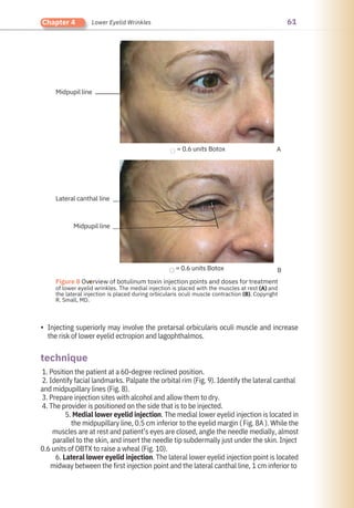 61
Chapter 4 Lower Eyelid Wrinkles
• Injecting superiorly may involve the pretarsal orbicularis oculi muscle and increase
the risk of lower eyelid ectropion and lagophthalmos.
1. Position the patient at a 60-degree reclined position.
2. Identify facial landmarks. Palpate the orbital rim (Fig. 9). Identify the lateral canthal
and midpupillary lines (Fig. 8).
3. Prepare injection sites with alcohol and allow them to dry.
4. The provider is positioned on the side that is to be injected.
5. Medial lower eyelid injection. The medial lower eyelid injection is located in
the midpupillary line, 0.5 cm inferior to the eyelid margin ( Fig. 8A ). While the
muscles are at rest and patient’s eyes are closed, angle the needle medially, almost
parallel to the skin, and insert the needle tip subdermally just under the skin. Inject
0.6 units of OBTX to raise a wheal (Fig. 10).
6. Lateral lower eyelid injection. The lateral lower eyelid injection point is located
midway between the first injection point and the lateral canthal line, 1 cm inferior to
technique
Midpupil line
Midpupil line
Lateral canthal line
= 0.6 units Botox
= 0.6 units Botox A
B
●
Figure 8 Overview of botulinum toxin injection points and doses for treatment
of lower eyelid wrinkles. The medial injection is placed with the muscles at rest (A) and
the lateral injection is placed during orbicularis oculi muscle contraction (B). Copyright
R. Small, MD.
 