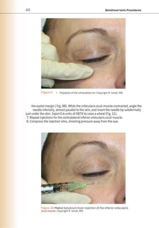 62 Botulinum toxin Procedures
Figure 9 ●
●
Palpation of the infraorbital rim. Copyright R. Small, MD.
Figure 10 Medial botulinum toxin injection of the inferior orbicularis
oculi muscle. Copyright R. Small, MD.
the eyelid margin ( Fig. 8B). While the orbicularis oculi muscle contracted, angle the
needle inferiorly, almost parallel to the skin, and insert the needle tip subdermally
just under the skin. Inject 0.6 units of OBTX to raise a wheal (Fig. 11).
7. Repeat injections for the contralateral inferior orbicularis oculi muscle.
8. Compress the injection sites, directing pressure away from the eye.
 