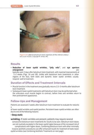 63
Chapter 4 Lower Eyelid Wrinkles
Results
Follow-Ups and Management
Duration of Effects and Treatment Intervals
•
•
•
Muscle function in the treatment area gradually returns 2.5–3 months after botulinum
toxin treatment.
Subsequent lower eyelid treatments with botulinum toxin may be performed when
the orbicularis oculi muscle begins to contract, before lines and wrinkles return to
their pretreatment appearance.
Patients are assessed 2 weeks after botulinum toxin treatment to evaluate for reductio
n
of lower eyelid wrinkles and eyelid position. Persistent lower eyelid wrinkles are often
due to one of the following reasons:
• Deep static
wrinkling. If static wrinkles are present, patients may require several
consecutive botulinum toxin treatments for results to be seen. Botulinum toxin doses
are not routinely escalated in the lower eyelid region because of the increased risk of
complications with higher doses. Combining botulinum toxin with other minimally
invasive aesthetic procedures can offer enhanced results for treatment of static lower
eyelid wrinkles (see Combining Aesthetic Treatments on next page).
Reduction of lower eyelid wrinkles, “jelly rolls”, and eye aperture
enlargement are
typically seen 3 days after botulinum toxin treatment, with maximal improvements at
1–2 weeks (Figs. 1A and 1B). Unlike with botulinum toxin treatments in other
regions of the face, both static and dynamic lower eyelid wrinkles usually
respond well to treatment.
●
Figure 11 Lateral botulinum toxin injection of the inferior orbicu-
laris oculi muscle. Copyright R. Small, MD.
 