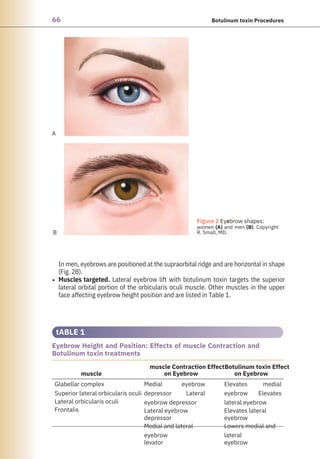 66 Botulinum toxin Procedures
In men, eyebrows are positioned at the supraorbital ridge and are horizontal in shape
(Fig. 2B).
Muscles targeted. Lateral eyebrow lift with botulinum toxin targets the superior
lateral orbital portion of the orbicularis oculi muscle. Other muscles in the upper
face affecting eyebrow height position and are listed in Table 1.
•
tABLE 1
Eyebrow Height and Position: Effects of muscle Contraction and
Botulinum toxin treatments
muscle
muscle Contraction Effect
on Eyebrow
Botulinum toxin Effect
on Eyebrow
Glabellar complex
Superior lateral orbicularis oculi
Lateral orbicularis oculi
Frontalis
Medial eyebrow
depressor Lateral
eyebrow depressor
Lateral eyebrow
depressor
Medial and lateral
eyebrow
levator
Elevates medial
eyebrow Elevates
lateral eyebrow
Elevates lateral
eyebrow
Lowers medial and
lateral
eyebrow
A
B
●
Figure 2 Eyebrow shapes:
women (A) and men (B). Copyright
R. Small, MD.
 