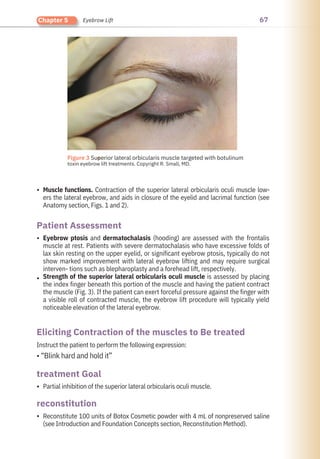 67
Chapter 5 Eyebrow Lift
•
•
•
•
•
Instruct the patient to perform the following expression:
• “Blink hard and hold it”
Partial inhibition of the superior lateral orbicularis oculi muscle.
Reconstitute 100 units of Botox Cosmetic powder with 4 mL of nonpreserved saline
(see Introduction and Foundation Concepts section, Reconstitution Method).
Muscle functions. Contraction of the superior lateral orbicularis oculi muscle low-
ers the lateral eyebrow, and aids in closure of the eyelid and lacrimal function (see
Anatomy section, Figs. 1 and 2).
Eyebrow ptosis and dermatochalasis (hooding) are assessed with the frontalis
muscle at rest. Patients with severe dermatochalasis who have excessive folds of
lax skin resting on the upper eyelid, or significant eyebrow ptosis, typically do not
show marked improvement with lateral eyebrow lifting and may require surgical
interven- tions such as blepharoplasty and a forehead lift, respectively.
Strength of the superior lateral orbicularis oculi muscle is assessed by placing
the index finger beneath this portion of the muscle and having the patient contract
the muscle (Fig. 3). If the patient can exert forceful pressure against the finger with
a visible roll of contracted muscle, the eyebrow lift procedure will typically yield
noticeable elevation of the lateral eyebrow.
reconstitution
treatment Goal
Patient Assessment
Eliciting Contraction of the muscles to Be treated
●
Figure 3 Superior lateral orbicularis muscle targeted with botulinum
toxin eyebrow lift treatments. Copyright R. Small, MD.
 