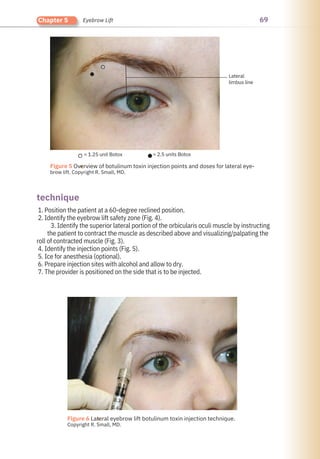 69
Chapter 5 Eyebrow Lift
technique
1. Position the patient at a 60-degree reclined position.
2. Identify the eyebrow lift safety zone (Fig. 4).
3. Identify the superior lateral portion of the orbicularis oculi muscle by instructing
the patient to contract the muscle as described above and visualizing/palpating the
roll of contracted muscle (Fig. 3).
4. Identify the injection points (Fig. 5).
5. Ice for anesthesia (optional).
6. Prepare injection sites with alcohol and allow to dry.
7. The provider is positioned on the side that is to be injected.
= 1.25 unit Botox = 2.5 units Botox
Lateral
limbus line
●
●
Figure 6 Lateral eyebrow lift botulinum toxin injection technique.
Copyright R. Small, MD.
Figure 5 Overview of botulinum toxin injection points and doses for lateral eye-
brow lift. Copyright R. Small, MD.
 