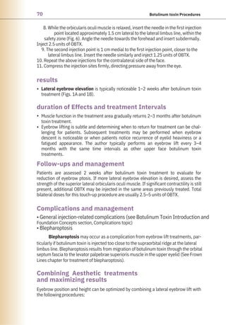 70 Botulinum toxin Procedures
Lateral eyebrow elevation is typically noticeable 1–2 weeks after botulinum toxin
treatment (Figs. 1A and 1B).
Eyebrow position and height can be optimized by combining a lateral eyebrow lift with
the following procedures:
Muscle function in the treatment area gradually returns 2–3 months after botulinum
toxin treatment.
Eyebrow lifting is subtle and determining when to return for treatment can be chal-
lenging for patients. Subsequent treatments may be performed when eyebrow
descent is noticeable or when patients notice recurrence of eyelid heaviness or a
fatigued appearance. The author typically performs an eyebrow lift every 3–4
months with the same time intervals as other upper face botulinum toxin
treatments.
8. While the orbicularis oculi muscle is relaxed, insert the needle in the first injection
point located approximately 1.5 cm lateral to the lateral limbus line, within the
safety zone (Fig. 6). Angle the needle towards the forehead and insert subdermally.
Inject 2.5 units of OBTX.
9. The second injection point is 1 cm medial to the first injection point, closer to the
lateral limbus line. Insert the needle similarly and inject 1.25 units of OBTX.
10. Repeat the above injections for the contralateral side of the face.
11. Compress the injection sites firmly, directing pressure away from the eye.
Patients are assessed 2 weeks after botulinum toxin treatment to evaluate for
reduction of eyebrow ptosis. If more lateral eyebrow elevation is desired, assess the
strength of the superior lateral orbicularis oculi muscle. If significant contractility is still
present, additional OBTX may be injected in the same areas previously treated. Total
bilateral doses for this touch-up procedure are usually 2.5–5 units of OBTX.
• General injection-related complications (see Botulinum Toxin Introduction and
Foundation Concepts section, Complications topic)
• Blepharoptosis
Blepharoptosis may occur as a complication from eyebrow lift treatments, par-
ticularly if botulinum toxin is injected too close to the supraorbital ridge at the lateral
limbus line. Blepharoptosis results from migration of botulinum toxin through the orbital
septum fascia to the levator palpebrae superioris muscle in the upper eyelid (See Frown
Lines chapter for treatment of blepharoptosis).
results
Follow-ups and management
Complications and management
Combining Aesthetic treatments
and maximizing results
duration of Effects and treatment Intervals
•
•
•
 