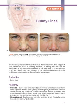 73
A B
Chapter 6
Bunny Lines
Bunny lines
Bunny lines, or nasalis rhytids, are wrinkles formed on the lateral and
dorsal aspects of the nose. They typically course diagonally over the nasal sidewalls
and nasal bridge (Fig. 1A and see Anatomy section, Figs. 4 and 5). Transverse lines
across the root of the nose are not related to the nasalis muscle but rather are due to
contraction of the procerus muscle seen with frowning (Fig. 2).
Muscles targeted. Botulinum toxin bunny line treatment targets the nasalis muscle
(see Anatomy section, Figs. 1 and 2).
Dynamic bunny lines result from contraction of the nasalis muscle. They are part of
facial expressions such as frowning, squinting, or smiling and may also be
accentuated by botulinum toxin treatments in the upper face for frown lines and
crow’s feet. Botuli- num toxin treatment of the nasalis reduces bunny lines by
inhibiting muscle contraction and smoothing the overlying skin.
Anatomy
Indication
•
•
• Wrinkles.
●
Figure 1 Bunny lines before (A) and 2 weeks after (B) botulinum toxin treatment of
the nasalis muscle, with active nasal scrunching. Copyright R. Small, MD.
BotuLInum toxIn ProCedures
 