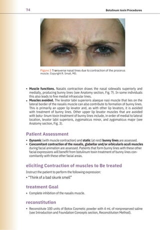 74 Botulinum toxin Procedures
•
•
•
•
•
•
Complete inhibition of the nasalis muscle.
Instruct the patient to perform the following expression:
• “Think of a bad skunk smell”
Reconstitute 100 units of Botox Cosmetic powder with 4 mL of nonpreserved saline
(see Introduction and Foundation Concepts section, Reconstitution Method).
Muscle functions. Nasalis contraction draws the nasal sidewalls superiorly and
medially, producing bunny lines (see Anatomy section, Fig. 7). In some individuals
this also leads to fine medial infraocular lines.
Muscles avoided. The levator labii superioris alaeque nasi muscle that lies on the
lateral border of the nasalis muscle can also contribute to formation of bunny lines.
This is primarily an upper lip levator and, as with other lip levators, it is avoided
with treatment of bunny lines. Other upper lip levator muscles that are avoided
with botu- linum toxin treatment of bunny lines include, in order of medial to lateral
location, levator labii superioris, zygomaticus minor, and zygomaticus major (see
Anatomy section, Fig. 3).
Dynamic (with muscle contraction) and static (at rest) bunny lines are assessed.
Concomitant contraction of the nasalis, glabellar and/or orbicularis oculi muscles
during facial animation are assessed. Patients that form bunny lines with these other
facial expressions will benefit from botulinum toxin treatment of bunny lines con-
comitantly with these other facial areas.
reconstitution
treatment Goal
Patient Assessment
eliciting Contraction of muscles to Be treated
●
Figure 2 Transverse nasal lines due to contraction of the procerus
muscle. Copyright R. Small, MD.
 