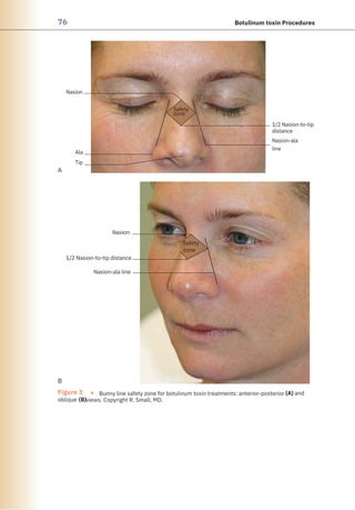 76 Botulinum toxin Procedures
Nasion
Ala
Tip
Safety
zone
1/2 Nasion-to-tip
distance
Nasion-ala
line
A
B
Figure 3 ●
oblique
Bunny line safety zone for botulinum toxin treatments: anterior-posterior
views. Copyright R. Small, MD.
and
(B)
(A)
Nasion
1/2 Nasion-to-tip distance
Nasion-ala line
Safety
zone
 