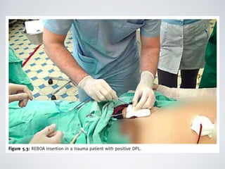 REBOA | PDF