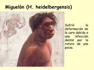Miguelón (H. heidelbergensis)


                         Sufrió         la
                         deformación de
                         la cara debido a
                         una    infección
                         dental por la
                         rotura de una
                         pieza.
 