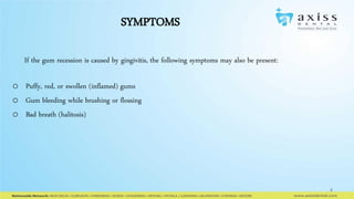 SYMPTOMS
If the gum recession is caused by gingivitis, the following symptoms may also be present:
o Puffy, red, or swollen (inflamed) gums
o Gum bleeding while brushing or flossing
o Bad breath (halitosis)

4

 