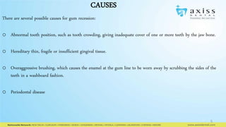 CAUSES
There are several possible causes for gum recession:
o Abnormal tooth position, such as tooth crowding, giving inadequate cover of one or more teeth by the jaw bone.
o Hereditary thin, fragile or insufficient gingival tissue.
o Overaggressive brushing, which causes the enamel at the gum line to be worn away by scrubbing the sides of the
teeth in a washboard fashion.
o Periodontal disease

5

 