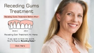 Receding Gums
Treatment
Before After
Receding Gums Treatment Before After
Receding Gum Treatment At Home
If you want to know the secret
How To Regrow Receding Gums?
Click Here
 