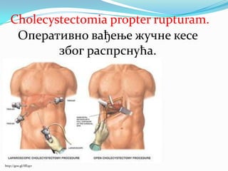 Оперативно вађење жучне кесе
због распрснућа.
http://goo.gl/IfE9yr
Cholecystectomia propter rupturam.
 