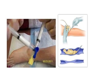 Tromboject Injection Recent advances in varicose veins and management | PPTX