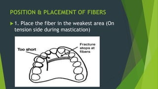 POSITION & PLACEMENT OF FIBERS
 1. Place the fiber in the weakest area (On
tension side during mastication)
 
