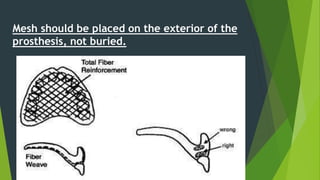 Mesh should be placed on the exterior of the
prosthesis, not buried.
 