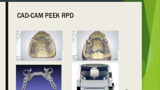 Recent advancements in denture base materials [autosaved]